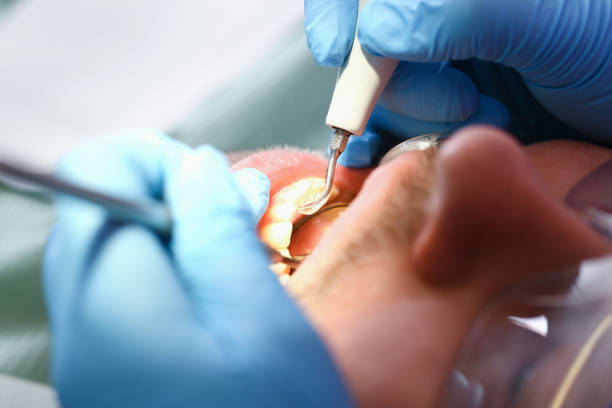 Best Emergency Root Canal Therapy in Ojus, FL